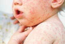 В Одесской области зафиксированы новые случаи кори, один из которых летальный